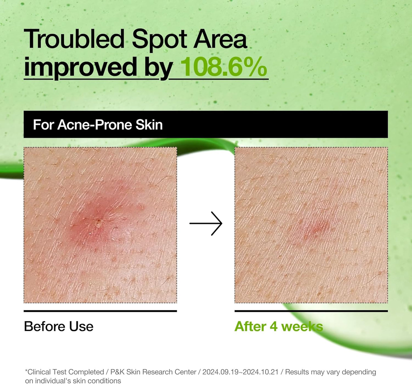 ANUA Azelaic Acid 10% + Hyaluron Redness Soothing Serum